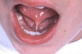 toddler with tongue tie